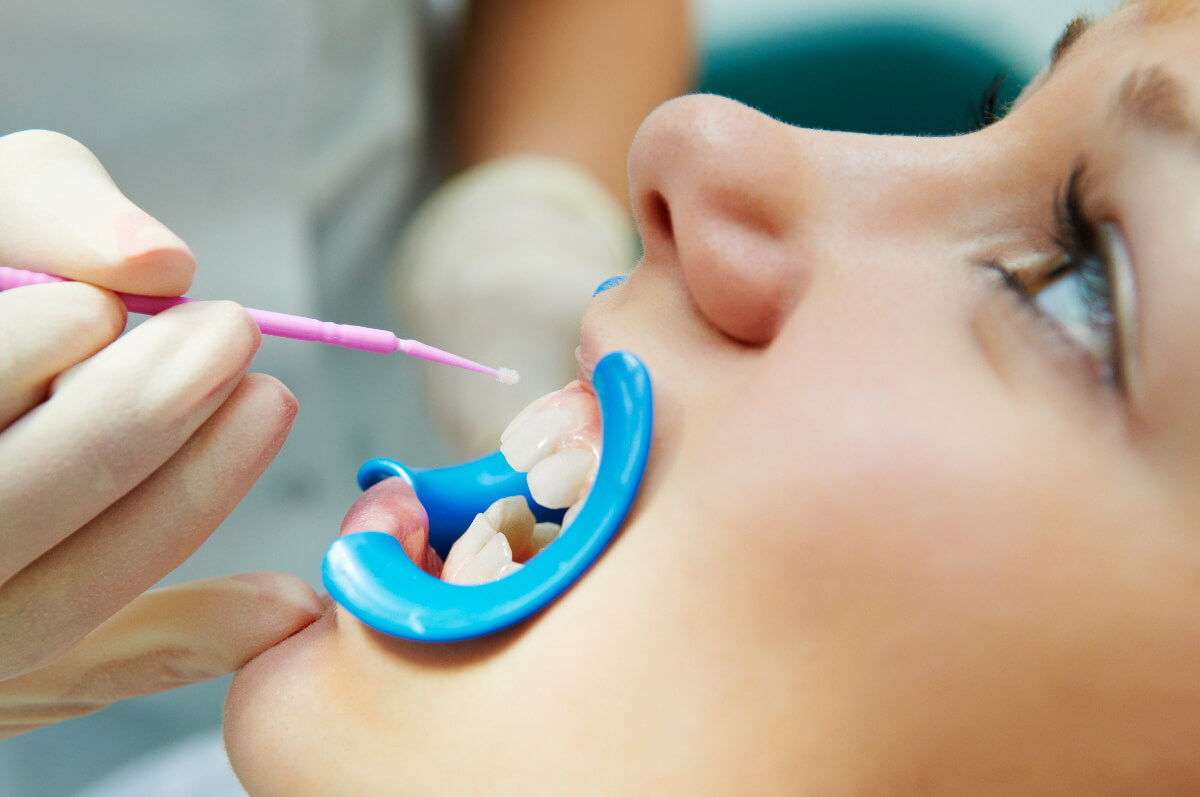 Dental Sealants: Reduce The Risk Of Cavities In Your Kid’s Mouth