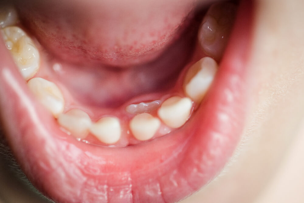 Why Does My Child Have Shark Teeth?