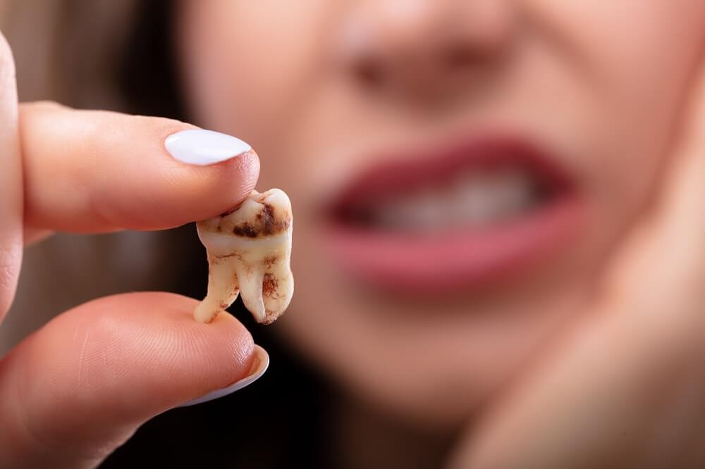 5 Signs of Tooth Decay in Children