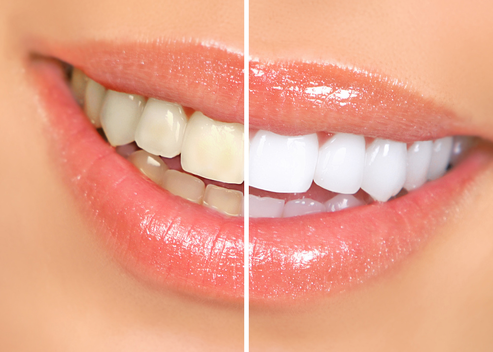 Is It Safe For Teenagers To Professionally Whiten Their Teeth?