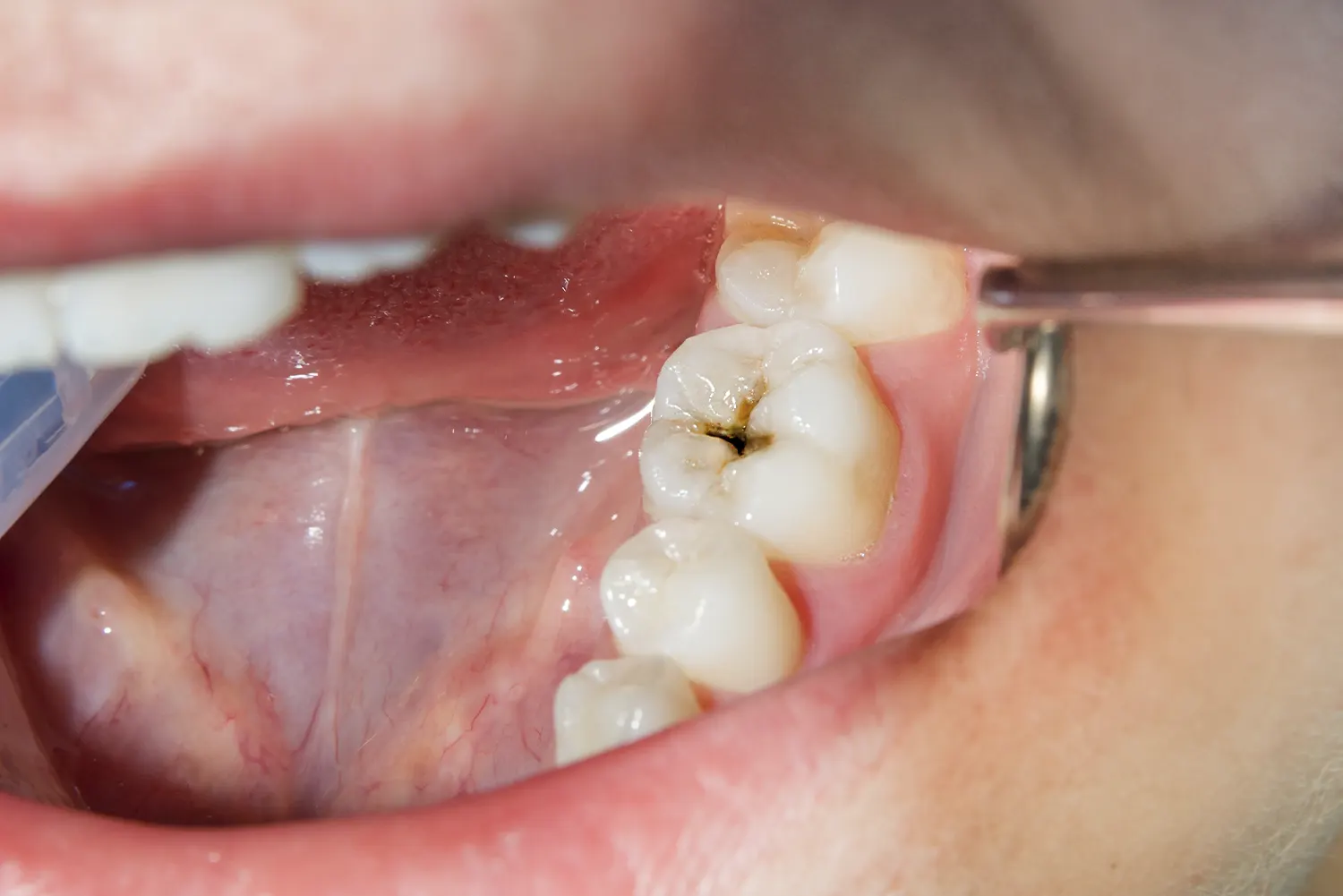 Tips To Prepare Your Child For A Cavity Filling