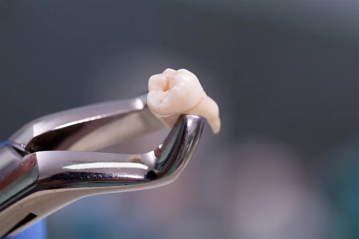 My Kids Knocked Out Their Tooth! Now What?
