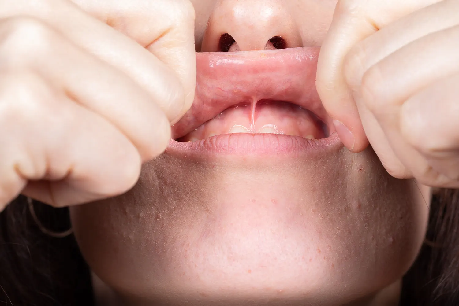 Understanding Frenectomy: A Guide for Parents