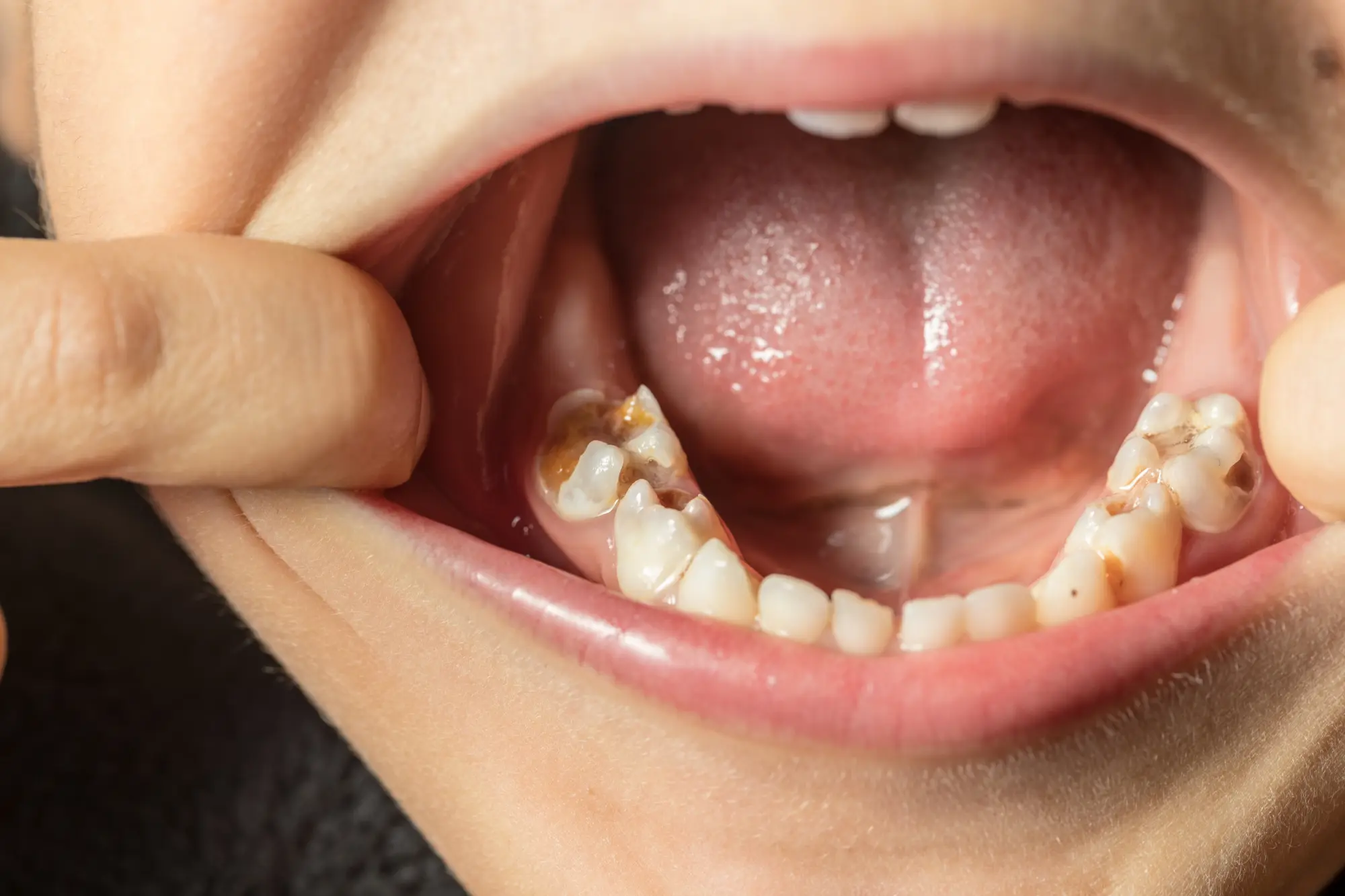 Cavity Care Without the Drill: The Benefits of Silver Diamine Fluoride (SDF) in Houston